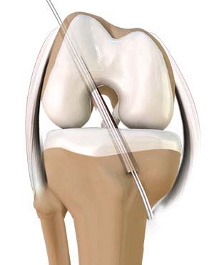 Lateral Approach Total Knee Replacements