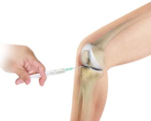 Cortisone Injections