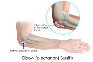 Olecranon (Elbow) Fracture