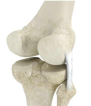 Posterolateral Instability