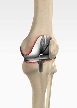 Revision Knee Surgery