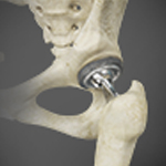 Total Hip Replacement