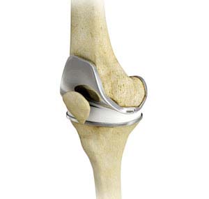 Hip Fracture